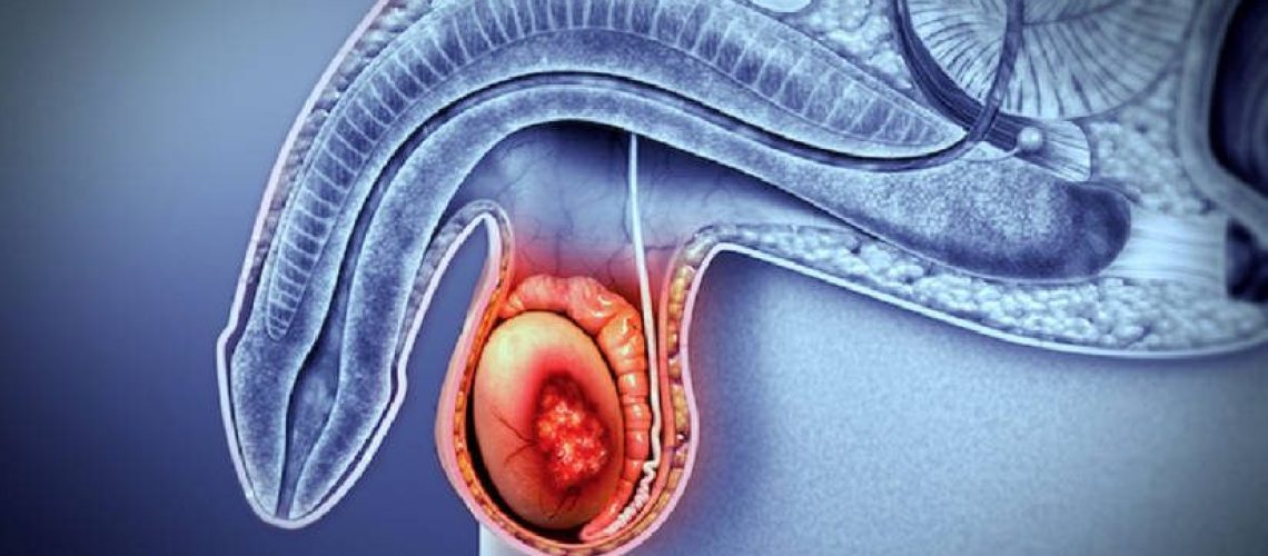 Boletin cancer de prostata