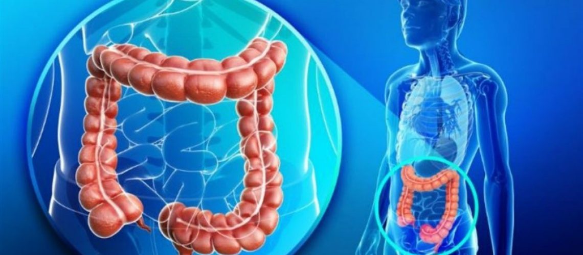 Cancer de colon